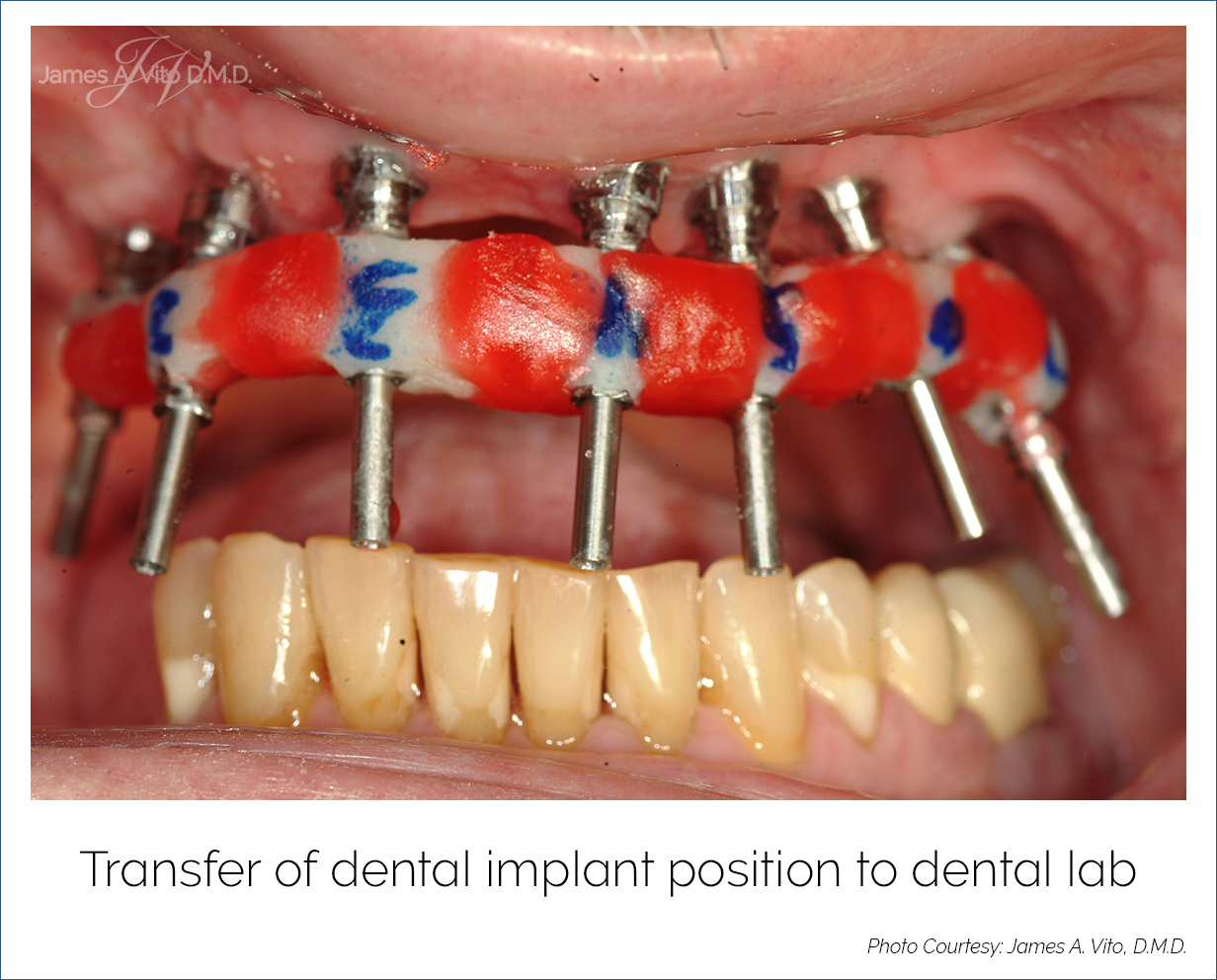 AllOnFour Dental Implants Wayne, Pennsylvania JAMES A VITO DMD